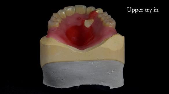 Newsletter 55 Provision of metal based partial dentures for Zephyrine with a repaired cleft lip and palate