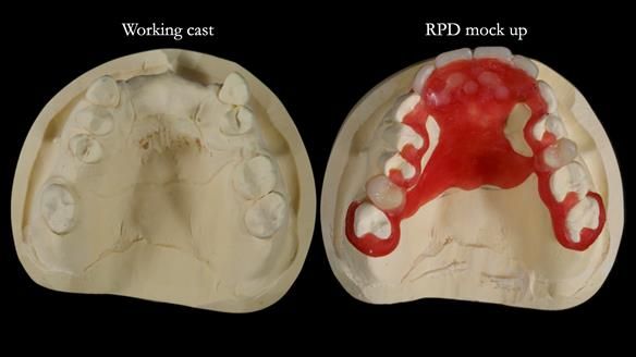 Newsletter 81 - Pam’s Story — how a partial denture changed her life (+ live walkthrough this Thursday)
