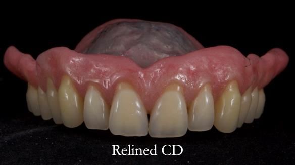 Finlay's Newsletter 62 provision of extractions and metal based complete dentures for Rafique