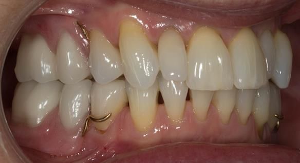 Figure 85 Definitive dentures fitted.