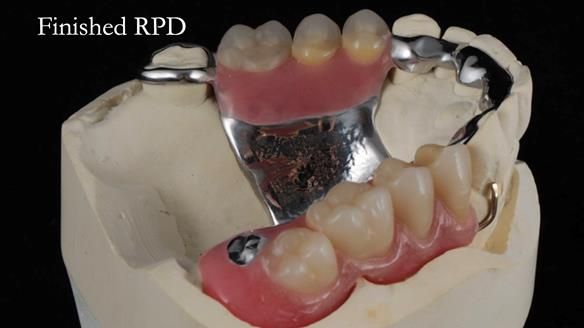 Finlay's Newsletter 60 Sylvia's upper Kennedy Class 2 Mod 1 metal based upper RPD