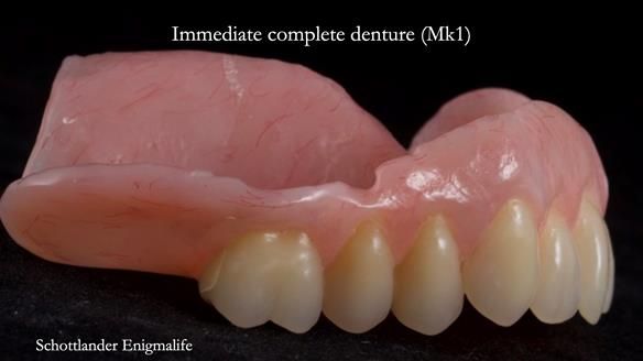 Newsletter 77: Jeremy’s case – immediate complete upper denture