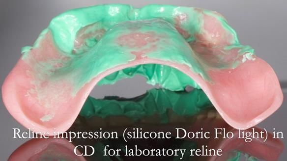 Finlay's Newsletter 62 provision of extractions and metal based complete dentures for Rafique