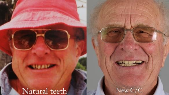 Complete denture Class II div 2 deep overbite Newsletter 39