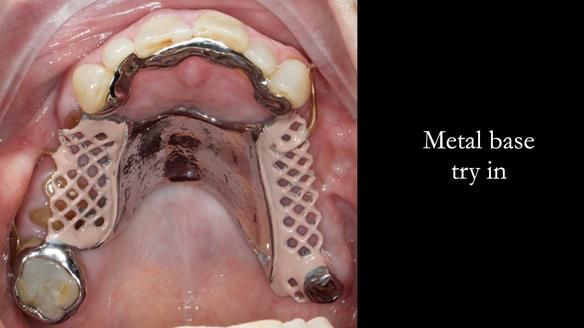 Finlay's Newsletter 60 Sylvia's upper Kennedy Class 2 Mod 1 metal based upper RPD