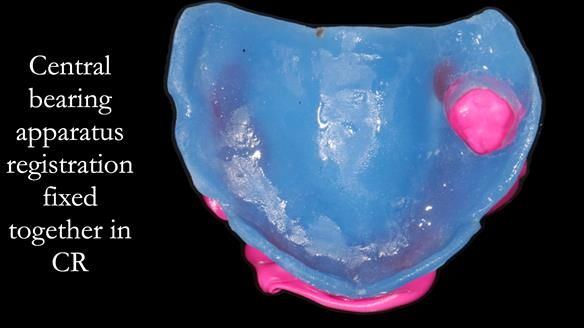Finlay's Newsletter 58 Gasket upper partial denture for Zoe