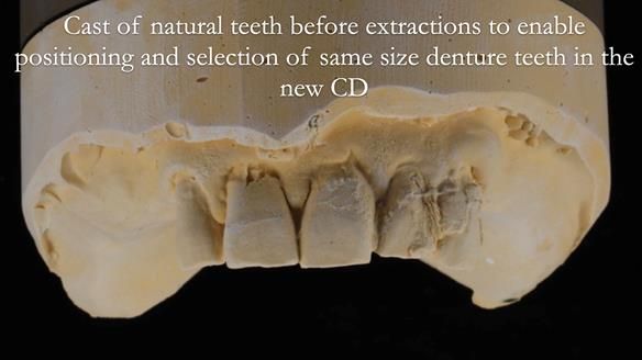 Finlay's Newsletter 62 provision of extractions and metal based complete dentures for Rafique