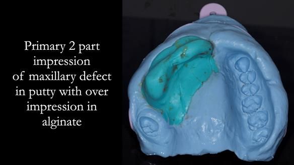 Upper metal base partial denture/occlusal stabilisation splint/obturator - full protocol
