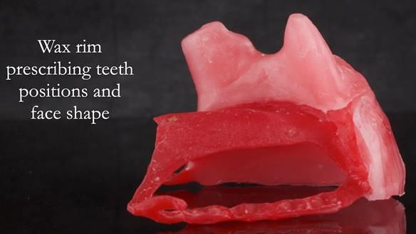 Upper metal base partial denture/occlusal stabilisation splint/obturator - full protocol