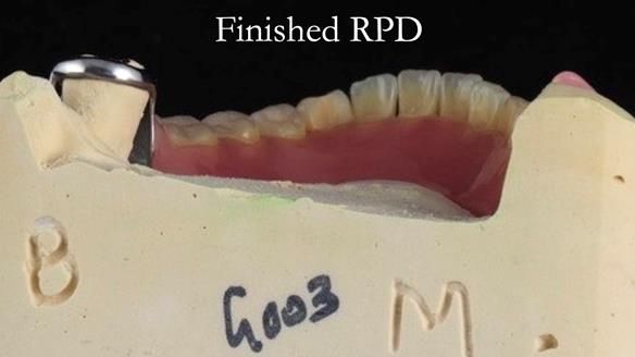 Finlay's Newsletter 59 Ultra hard partial dentures made for Gill