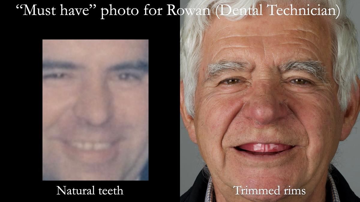 Fin’s Newsletter 88 — Complete dentures - full protocol… he rearranged his own teeth!