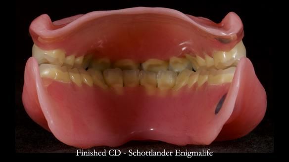 Newsletter 83: Sheila’s Complete Denture Success
