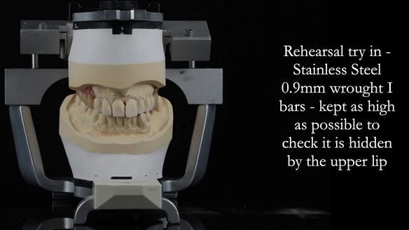 Newsletter 56 showing the making and fitting of a bilateral free end saddle upper removable partial denture (RPD) for patient with pemphigus