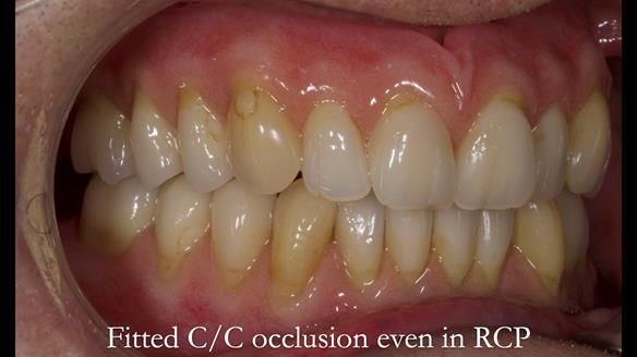 Newsletter 50 Special edition Complete Dentures FULL PROTOCOL