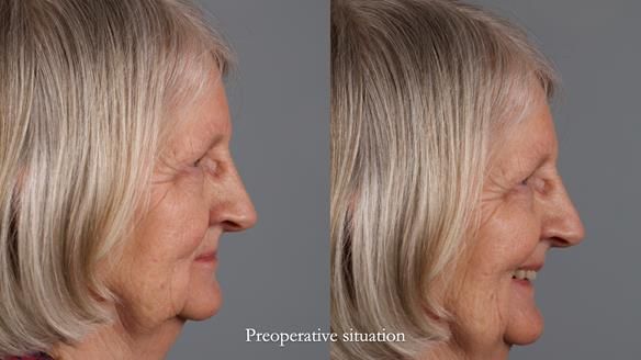 Newsletter 82 Mary - A complete upper and a one-tooth gasket denture