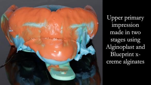 Solving Sue's failed implants with metal based RPD - full protocol Newsletter 43