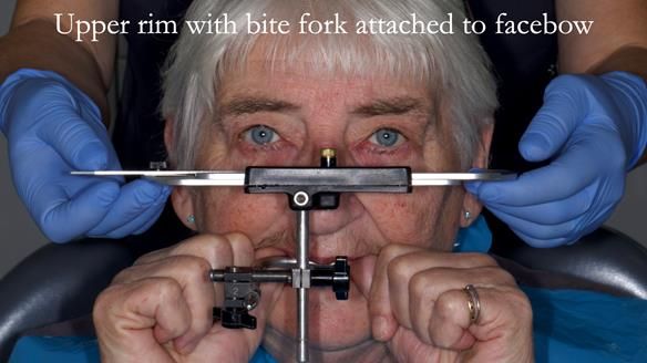 Newsletter 55 Provision of metal based partial dentures for Zephyrine with a repaired cleft lip and palate