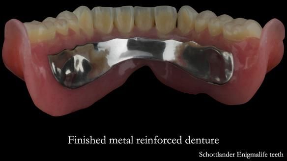 Finished metal reinforced implant supported over denture