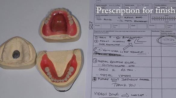 Newsletter 70 Complete Denture Treatment for Kate: A Case Study on Natural-Looking Dentures and Implant-Supported Overdentures