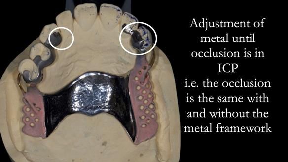 Solving Sue's failed implants with metal based RPD - full protocol Newsletter 43