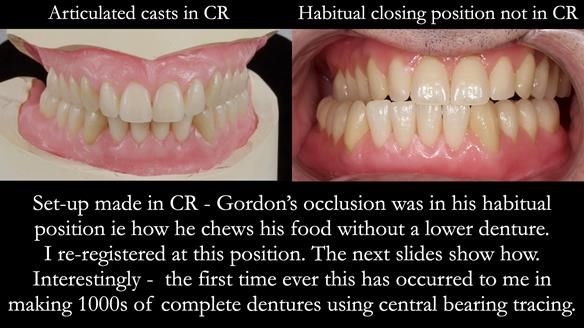 Newsletter 80 - Gordon’s dentures: the one case in 1,000 where my technique failed