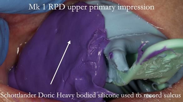Newsletter 51 Managing Anne’s failing dentition with distal extension base RPD/Splint FULL PROTOCOL