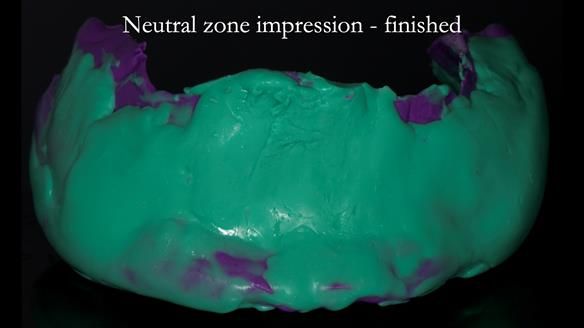 Newsletter 83: Sheila’s Complete Denture Success