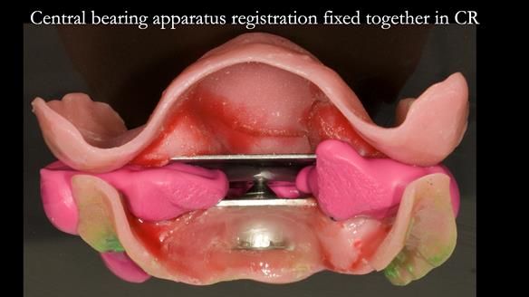 Newsletter 76: Jackie’s case – Telescopic overdenture & precision RPD (the tricky truth!)