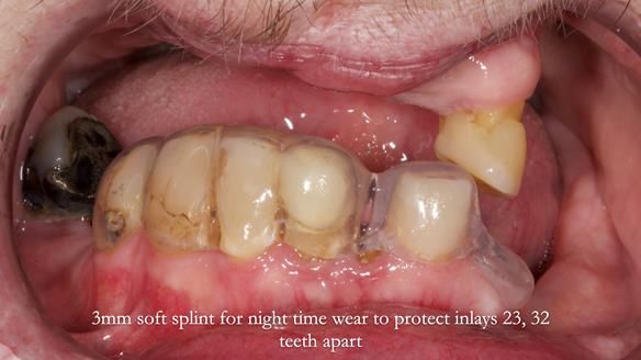 Newsletter 55 Provision of metal based partial dentures for Zephyrine with a repaired cleft lip and palate