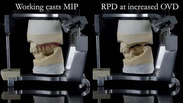 Finlay's Newsletter 60 Sylvia's upper Kennedy Class 2 Mod 1 metal based upper RPD