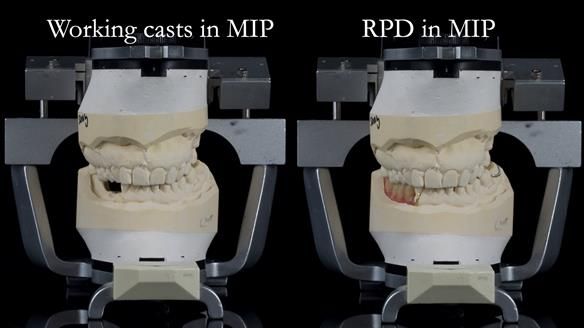 Finlay's Newsletter 61 provision of a lower unilateral free end saddle metal based partial denture for Joyce