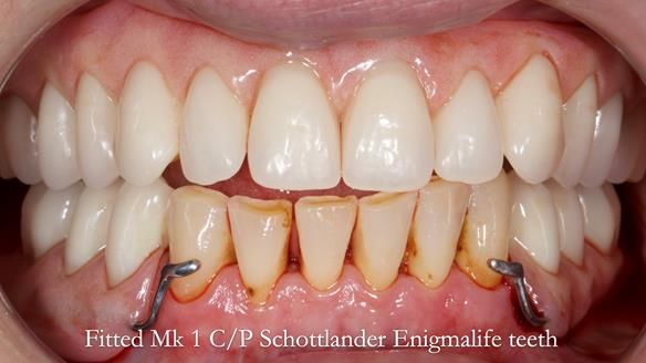 Newsletter 52 Managing Jo’s failing dentition with extractions and Mk 1/Mk 2 complete upper dentures and lower partial dentures FULL PROTOCOL
