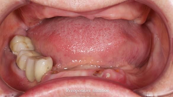 Newsletter 82 Mary - A complete upper and a one-tooth gasket denture