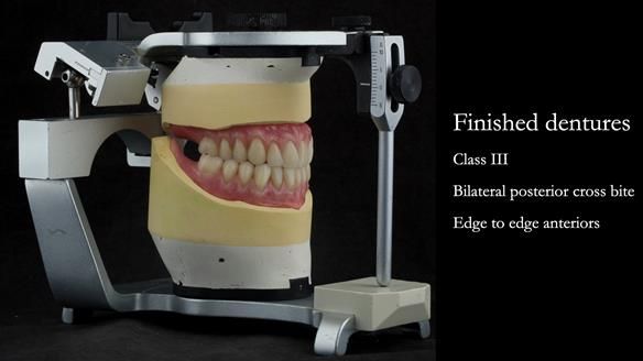 Finished dentures