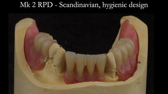 Finlay's Case Study Newsletter 40 - Immediate Mk 1 RPD to Definitive Mk 2 RPD - full protocol