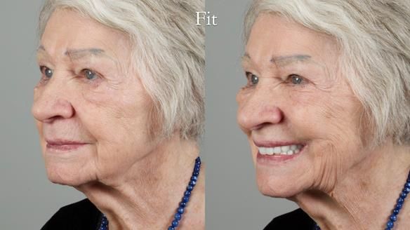 Newsletter 65 Marisa Provision of Complete Dentures on badly placed implants