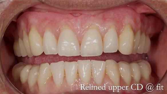 Finlay's Newsletter 62 provision of extractions and metal based complete dentures for Rafique
