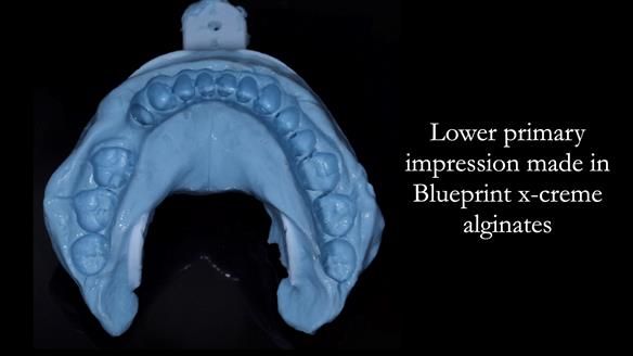 Solving Sue's failed implants with metal based RPD - full protocol Newsletter 43