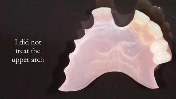 Newsletter 44 - extreme removable prosthodontics – engineering a super-strong and ultra-thin over denture