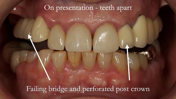 Newsletter 51 Managing Anne’s failing dentition with distal extension base RPD/Splint FULL PROTOCOL