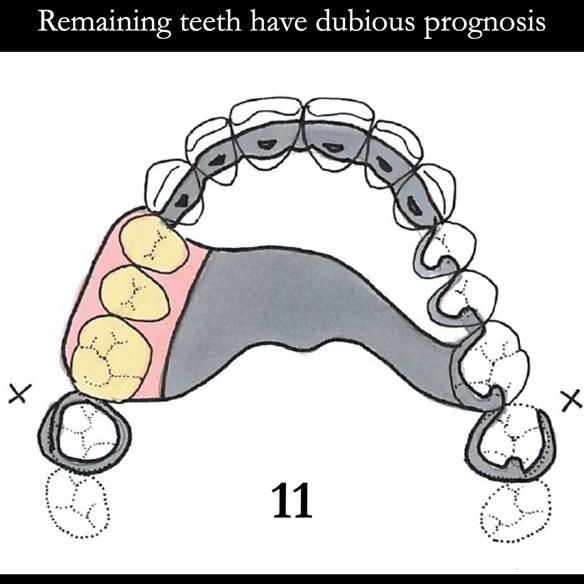 Universal Scandinavian partial denture designs