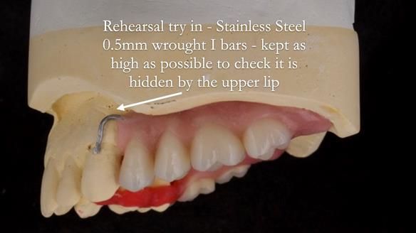 Solving Sue's failed implants with metal based RPD - full protocol Newsletter 43