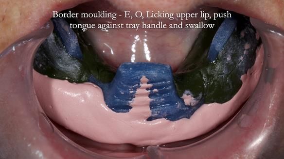 Newsletter 83: Sheila’s Complete Denture Success