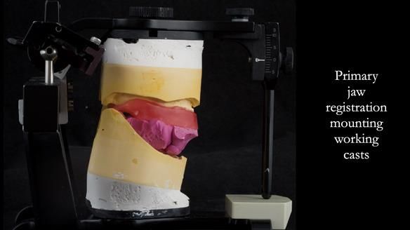 Complete denture Class II div 2 deep overbite Newsletter 39