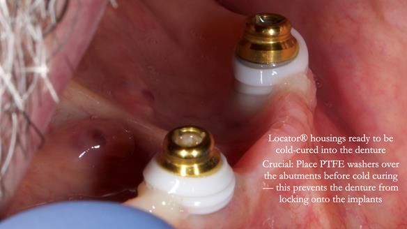 Newsletter 78: What do Clark Gable and a Locator® overdenture have in common?