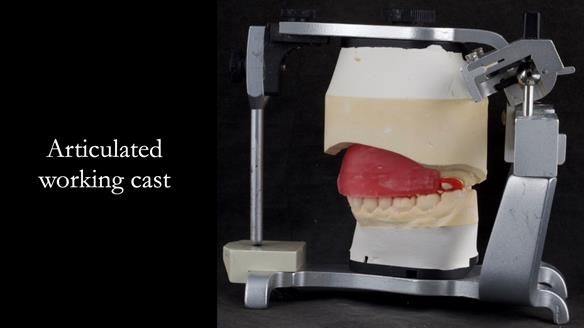Upper metal base partial denture/occlusal stabilisation splint/obturator - full protocol