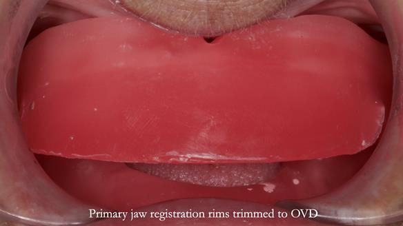 Newsletter 83: Sheila’s Complete Denture Success