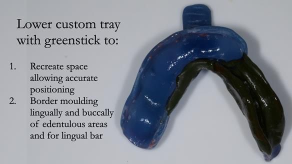 Newsletter 55 Provision of metal based partial dentures for Zephyrine with a repaired cleft lip and palate