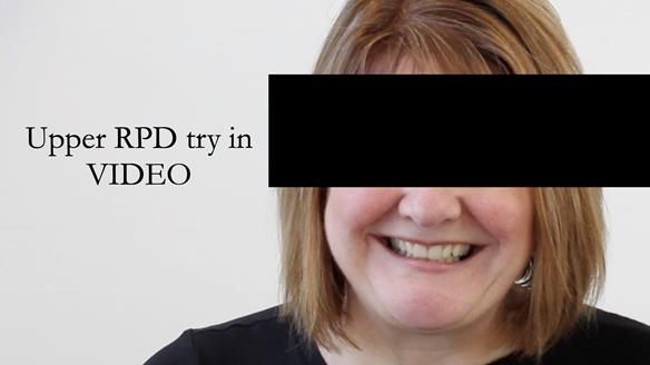 Finlay's Newsletter 58 Gasket upper partial denture for Zoe