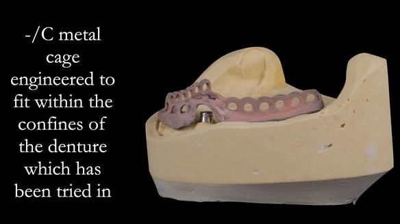 Managing poor implant positioning with complete dentures and Locator attachments - full protocol Newsletter 41